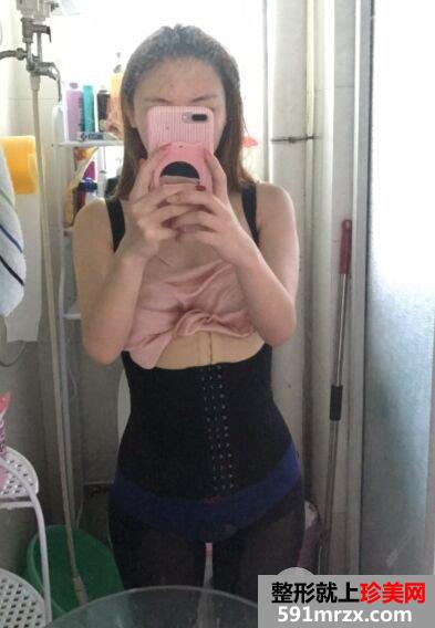 深圳臻瑞芝美整形价格表|腰腹吸脂真实案例小蛮腰立现