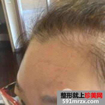 上海清杨整形价格表|抬头纹怎么治疗去皱效果图