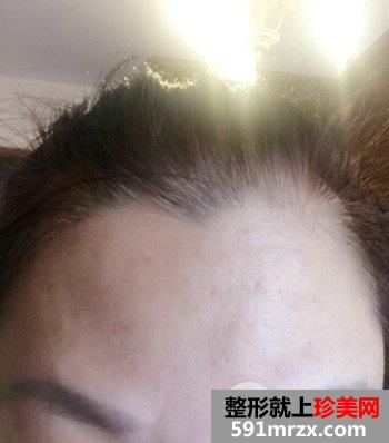 上海清杨整形价格表|抬头纹怎么治疗去皱效果图