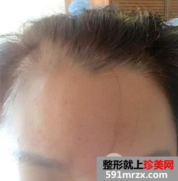 上海清杨整形价格表|抬头纹怎么治疗去皱效果图