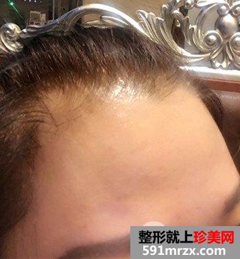 上海清杨整形价格表|抬头纹怎么治疗去皱效果图