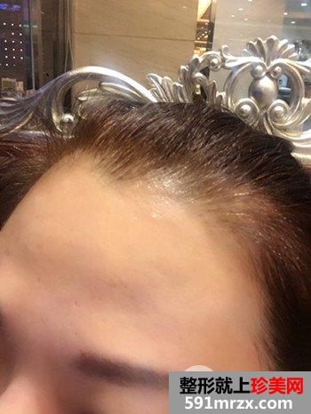 上海清杨整形价格表|抬头纹怎么治疗去皱效果图