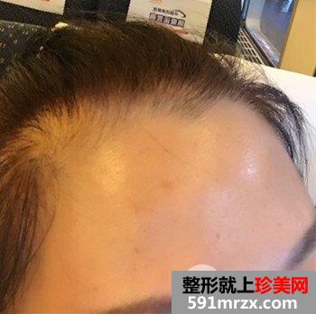 上海清杨整形价格表|抬头纹怎么治疗去皱效果图