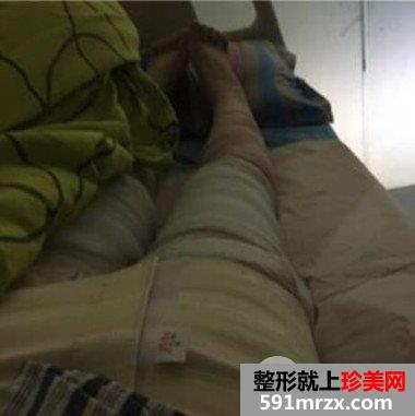 长沙素妍整形价格表|吸脂瘦腿案例分享立现筷子腿
