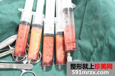 长沙素妍整形价格表|吸脂瘦腿案例分享立现筷子腿
