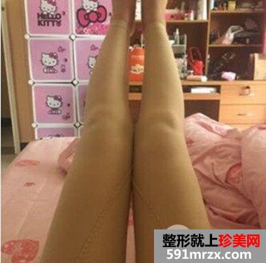 长沙素妍整形价格表|吸脂瘦腿案例分享立现筷子腿