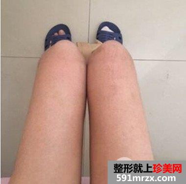 长沙素妍整形价格表|吸脂瘦腿案例分享立现筷子腿