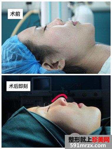 哈尔滨伊美尔整形价格表|隆鼻失败修复真实案例分享