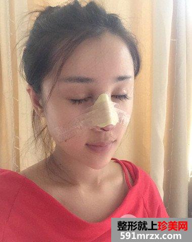哈尔滨伊美尔整形价格表|隆鼻失败修复真实案例分享