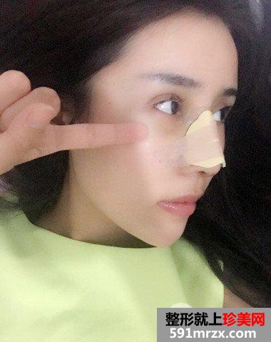 哈尔滨伊美尔整形价格表|隆鼻失败修复真实案例分享