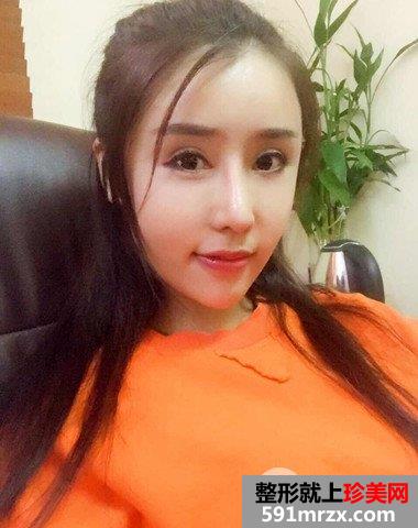 哈尔滨伊美尔整形价格表|隆鼻失败修复真实案例分享