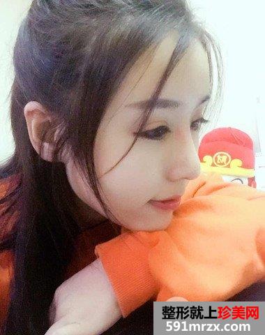 哈尔滨伊美尔整形价格表|隆鼻失败修复真实案例分享