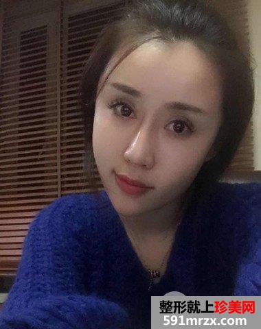 哈尔滨伊美尔整形价格表|隆鼻失败修复真实案例分享