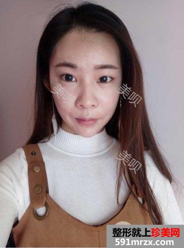 开眼角危险吗|双眼皮开眼角手术真实案例告诉你