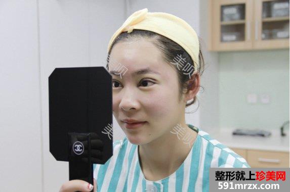 开眼角危险吗|双眼皮开眼角手术真实案例告诉你