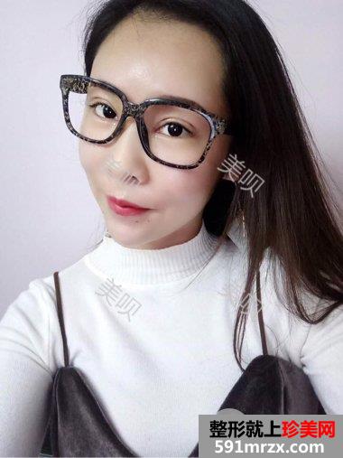 开眼角危险吗|双眼皮开眼角手术真实案例告诉你