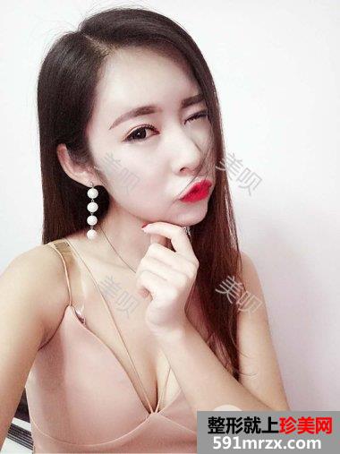 开眼角危险吗|双眼皮开眼角手术真实案例告诉你