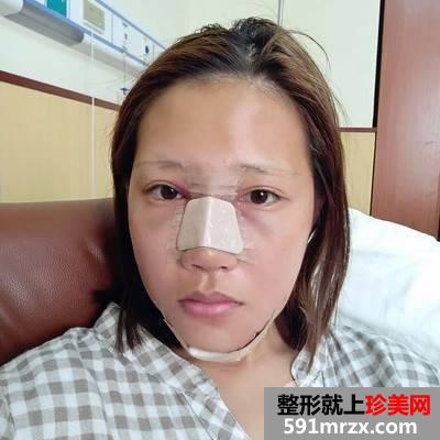垫下巴多长时间恢复|鼻综合+假体垫下巴真实案例分享