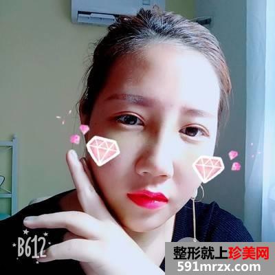 垫下巴多长时间恢复|鼻综合+假体垫下巴真实案例分享