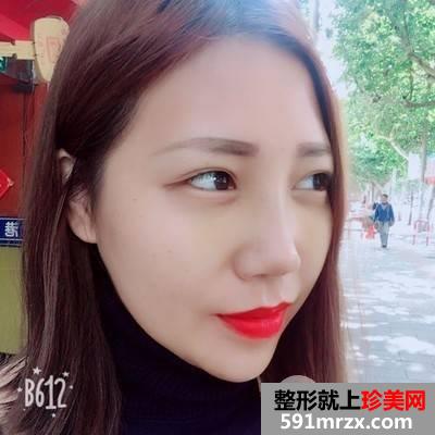 垫下巴多长时间恢复|鼻综合+假体垫下巴真实案例分享