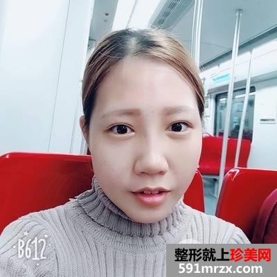 垫下巴多长时间恢复|鼻综合+假体垫下巴真实案例分享