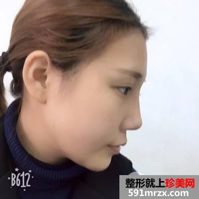 垫下巴多长时间恢复|鼻综合+假体垫下巴真实案例分享