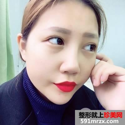 垫下巴多长时间恢复|鼻综合+假体垫下巴真实案例分享