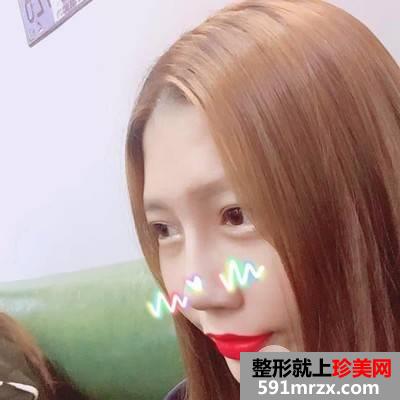 垫下巴多长时间恢复|鼻综合+假体垫下巴真实案例分享