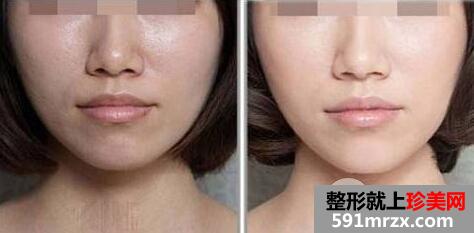 光子嫩肤的优势|光子嫩肤多少钱一次