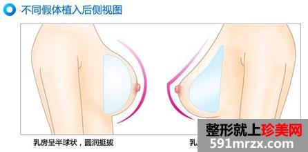 保定蓝山整形医院隆胸价格表新鲜出炉