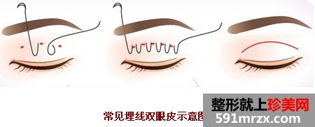 辽宁人民医院整形美容外科2017新价格表出炉