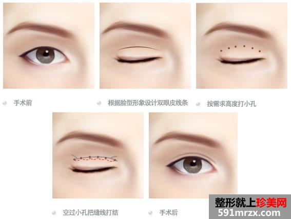 郑州虎珂整形医院价格表费用一览
