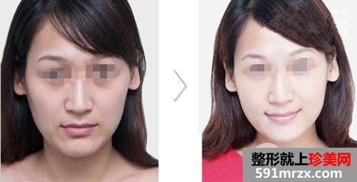 酒糟鼻怎么办，可以做光子嫩肤吗