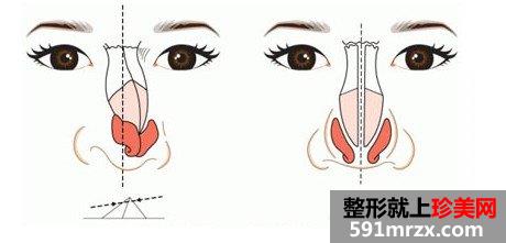 歪鼻子矫正有风险吗，效果怎么样