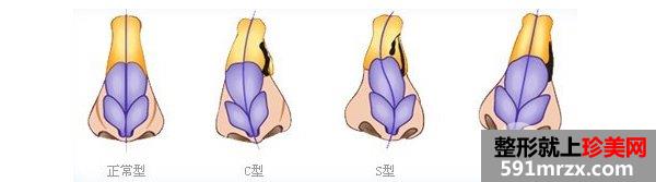 歪鼻子怎么办，可以矫正吗多少钱