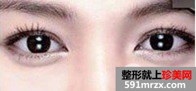 卧蚕和眼袋有什么区别，怎么区分