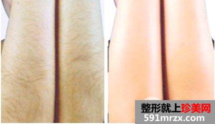冰点脱毛效果好不好，怎么样