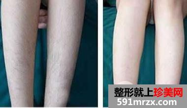 小腿脱毛能脱干净吗，效果好不好多少钱
