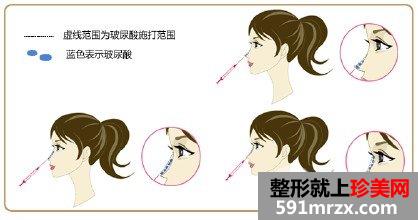 注射隆鼻的注射物可以取出吗，效果怎么样