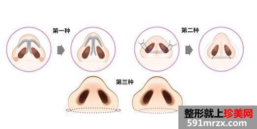 鼻翼肥大怎么办，可以缩小吗