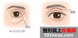 自体脂肪丰眼窝