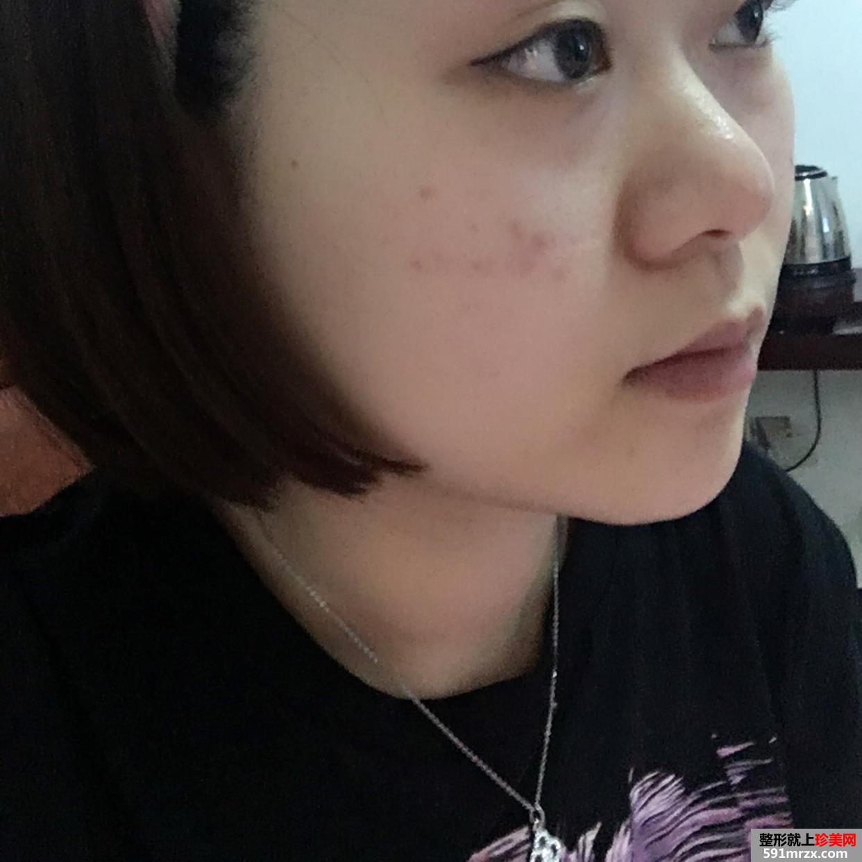 鼻头缩小手术一个月的恢复过程分享，还有前后对比效果图片哦~