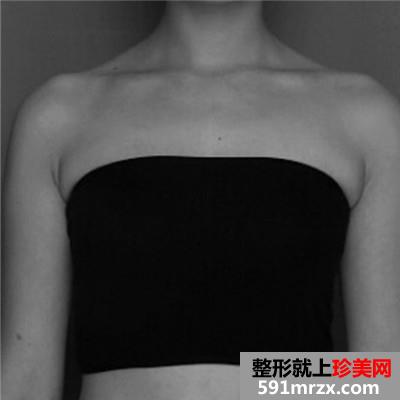 自体脂肪移植隆胸手术半年恢复过程分享，有前后对比效果图片~