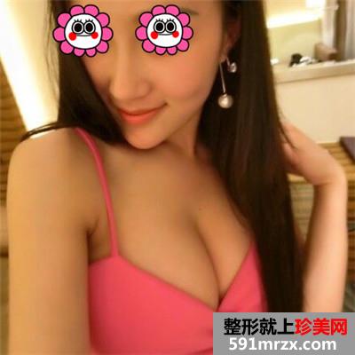 自体脂肪移植隆胸手术半年恢复过程分享，有前后对比效果图片~