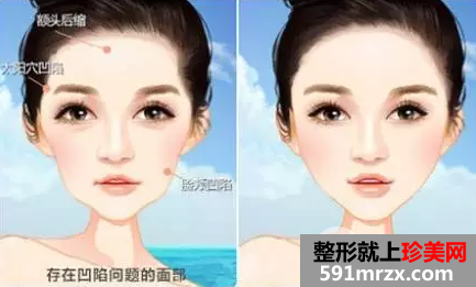 自体脂肪优于玻尿酸的地方