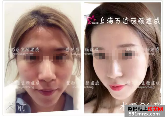 脂肪填充全脸
