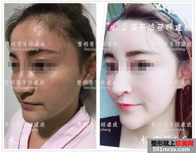脂肪填充全脸
