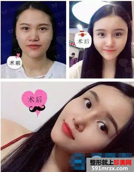 景熙翔院长鼻子整形和脂肪面部填充案例