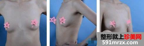 在广州军美整形医院做隆胸术前照