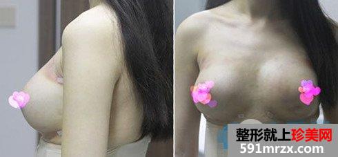 广州军美自体脂肪丰胸术后第1天照片